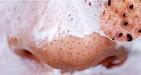 USE THIS SIMPLE AND EFFECTIVE TRICK AND GET RID OF BLACKHEADS