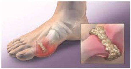 HOW TO QUICKLY REMOVE URIC ACID CRYSTALLIZATION FROM YOUR BODY TO PREVENT GOUT AND JOINT PAIN