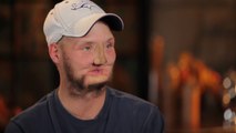 Man Receives ‘Miracle’ Face Transplant After Tragic Suicide Attempt