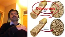 Osteoporosis (Fragile Bone ) Causes, Risk Factors, Treatment, Diagnosis, Prevention - Part 2