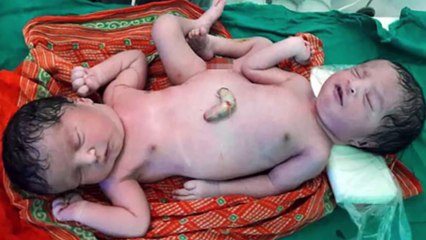 Mother shocked because conjoined twins exotic