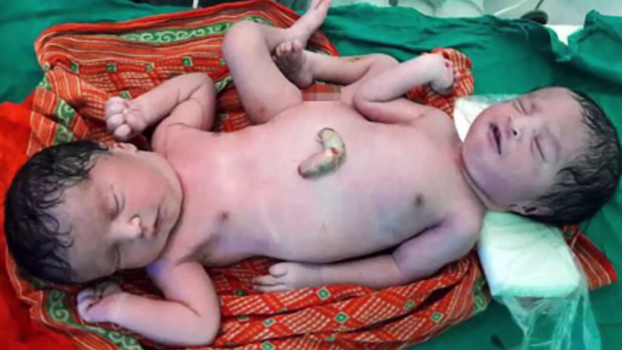 Mother shocked because conjoined twins exotic