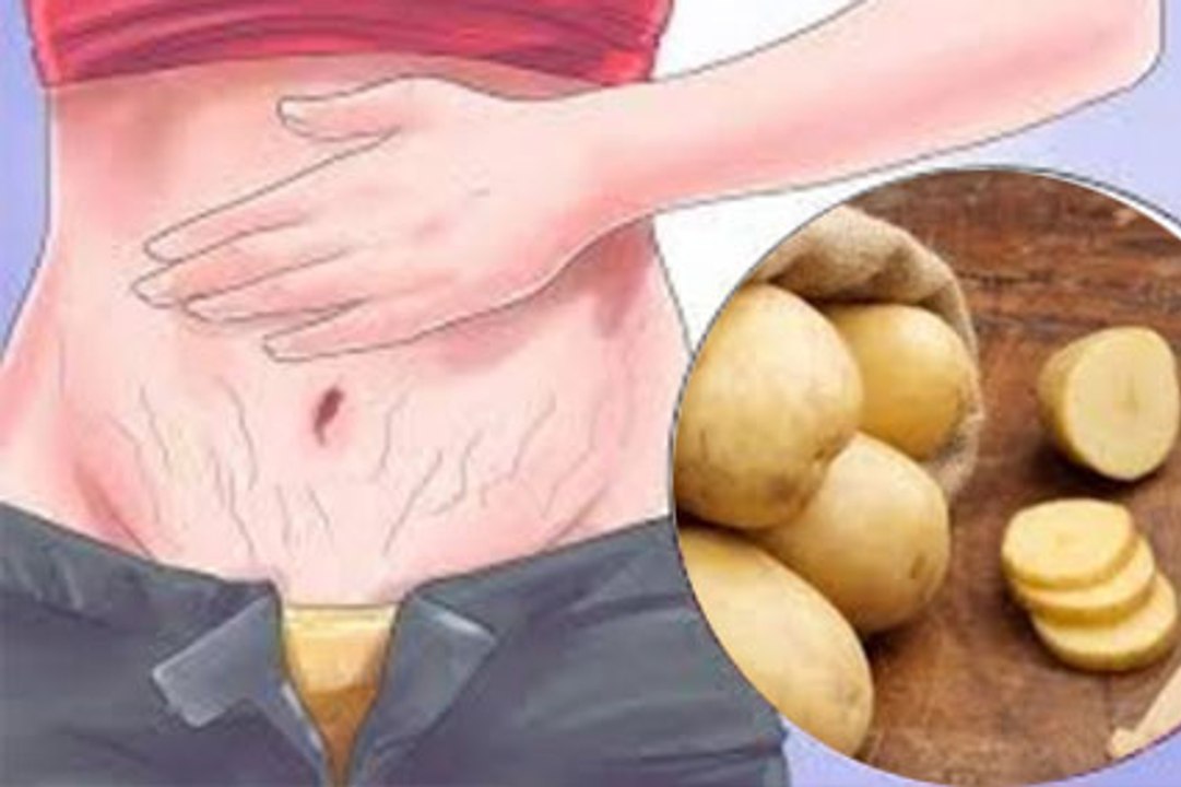 Como acabar com as ESTRIAS RAPIDAMENTE com BATATAS( INCRIVEL) e você vai adorar saber disso