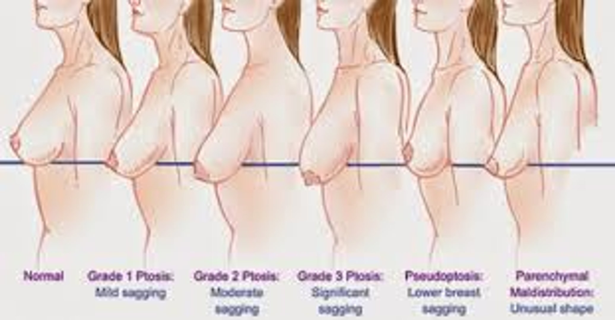 NATURAL PREVENTION OF SAGGING BREASTS - video Dailymotion