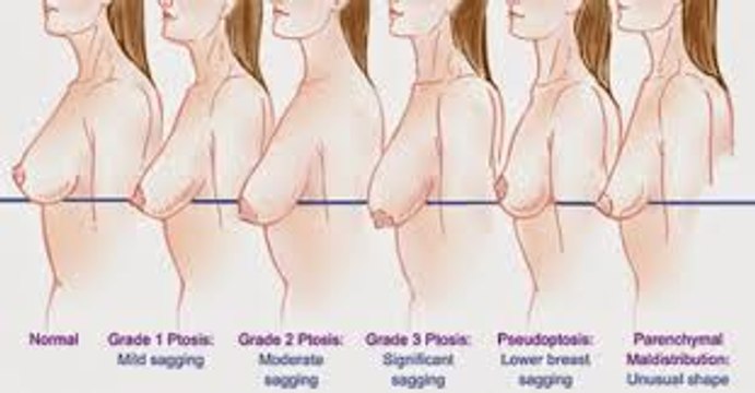 NATURAL PREVENTION OF SAGGING BREASTS