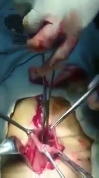 Ils lui retrouvent des brosses à dents dans l'estomac !