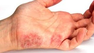 104.  Home Remedies For Psoriasis In Feet
