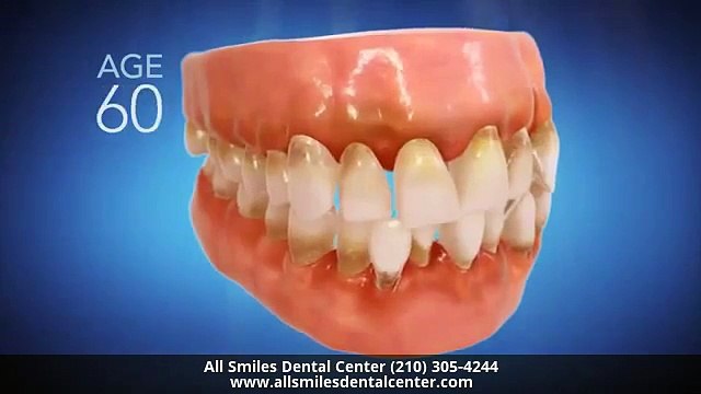 Invisalign Dentist San Antonio TX