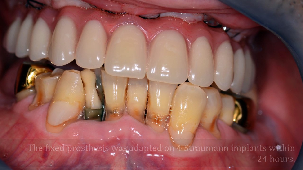 Implantation with Straumann implants