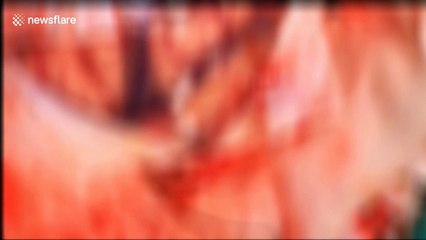 Doctor removes huge live parasite from woman's head