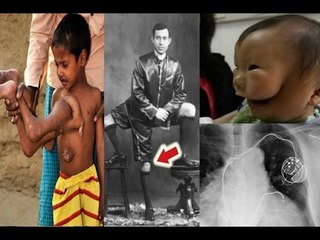 Những dị nhân ‘mọc’ thêm bộ phận cơ thể khó mà tin được?