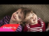 Chuyện lạ Việt Nam - Cặp song sinh dính liền đầu đặc biệt nhất thế giới