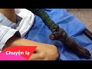 Chuyện lạ Việt Nam - Chân teo như cành củi khô vì bị rắn cắn