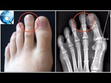 Ngón chân trỏ dài hơn ngón chân cái và cái kết chỉ 15% dân số thế giới phải chịu