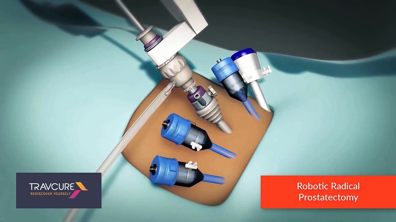 Robotic Prostatectomy - Most Advanced Prostate Cancer Treatments | SurgeryLog