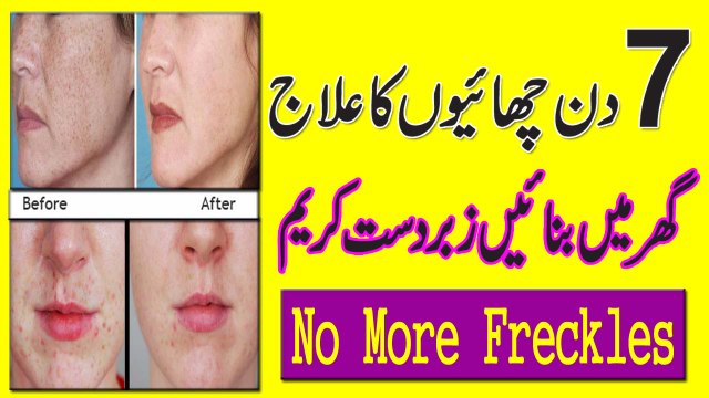 Remove Freckles On Face In Urdu | Chehre Ki Chaiyon Ka Garelu Ilaaj
