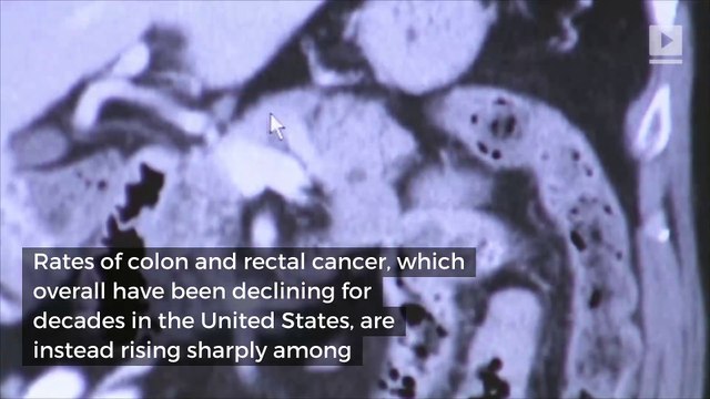 Colon and rectal cancers rates rising sharply among Gen X and millennials