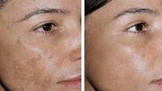 116. Two Ingredients say goodbye to wrinkles and sagging facial skin with this simple recipe. It's amazing.!