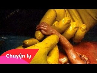 Chuyện lạ có thật - Thai nhi trong bụng mẹ bắt tay với bác sĩ