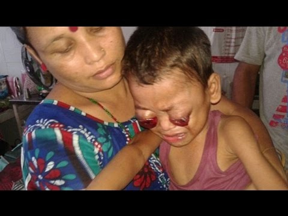 Ấn Độ: Cậu bé đáng thương mắc bệnh lạ, mắt lồi như sắp rớt ra ngoài