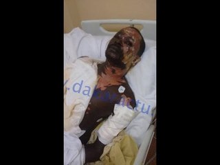 Babacar Mbaye,  ébouillanté par son épouse témoigne...