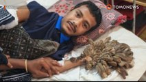 Homem árvore de Bangladesh curado após 16 cirurgias.