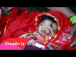 Chuyện lạ có thật - Em bé mới sinh có mũi “vòi voi”