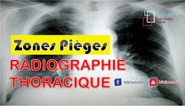 Radiographie du Thorax - Les Zones Pièges à vérifier sur une radiographie du thorax