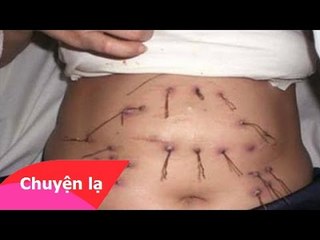Chuyện lạ Việt Nam - Bệnh nhân mọc 2000 cây đinh từ trong cơ thể