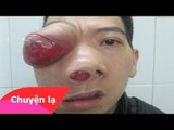 Chuyện lạ Việt Nam – Người đàn ông mang khối u lạ ở mắt