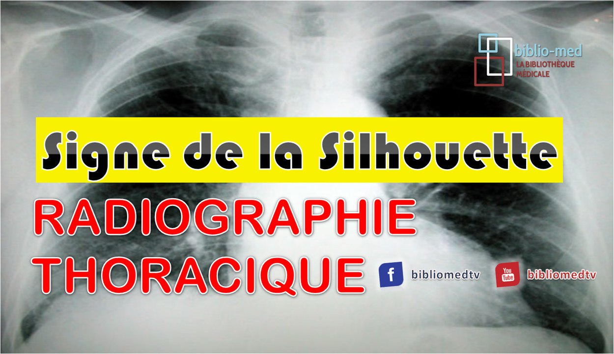 Radiographie du Thorax - Principes d’interprétation (Signe de la ...