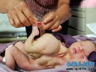 Chuyện lạ Việt Nam - Em bé có 4 tay 4 chân