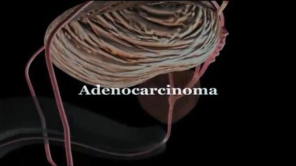 Adenocarcinoma - ANIMATED MEDICAL DICTIONARY