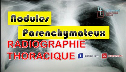 Radiographie du Thorax - Nodule Parenchymateux