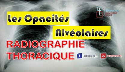 Radiographie du Thorax - Opacité Alvéolaire