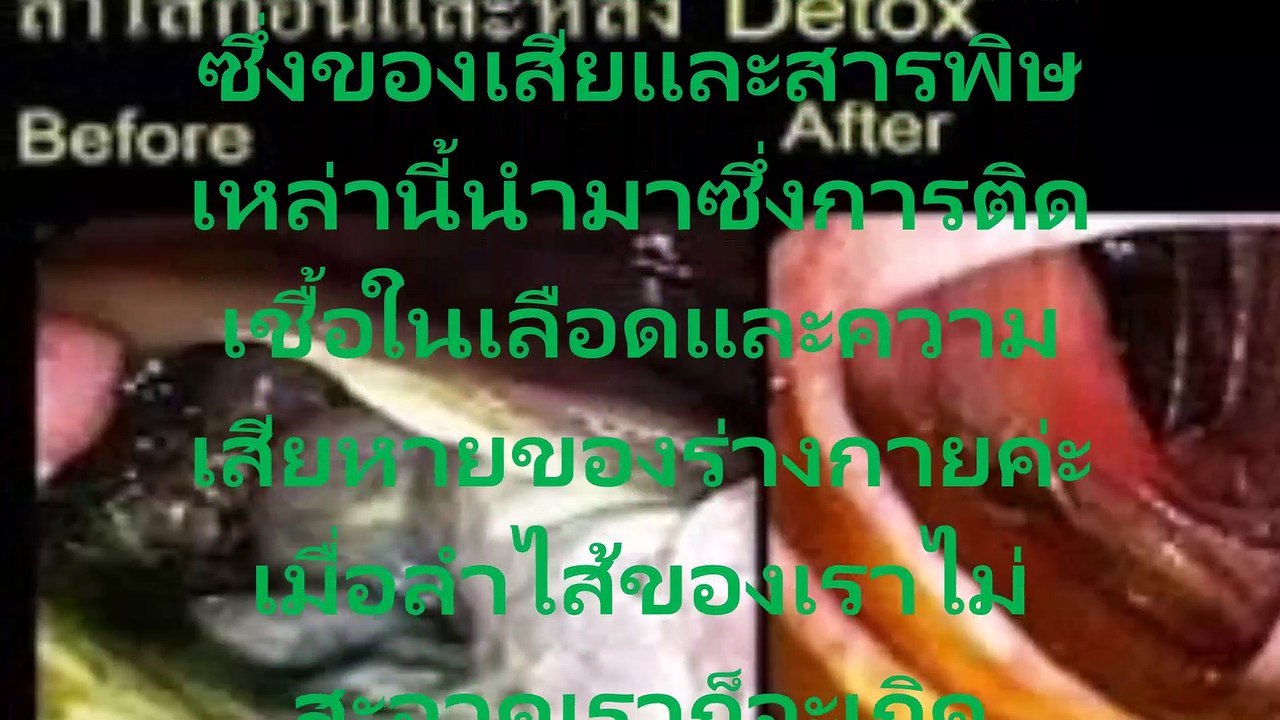วิธีการล้างลำไส้  ด้วยน้ำมันเมล็ดแฟลกซ์ ที่เห็นผล ได้ภายใน 3 สัปดาห์ ทางคุณหมอการันตี ปลอดภัย