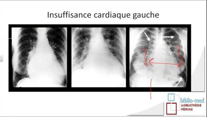 Cardiologie - Oedème Aigu Pulmonaire