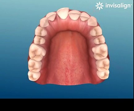 Invisalign - How Invisalign Aligners Straighten Your Teeth