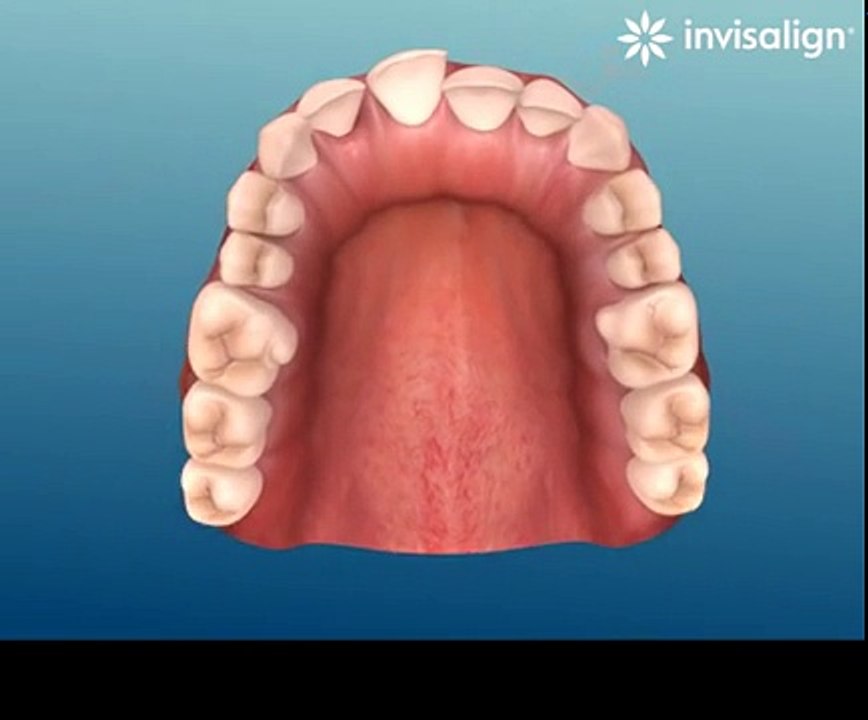 Invisalign - How Invisalign Aligners Straighten Your Teeth