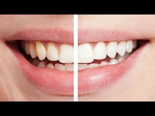 How to whiten teeth naturally at home, find out | Boldsky