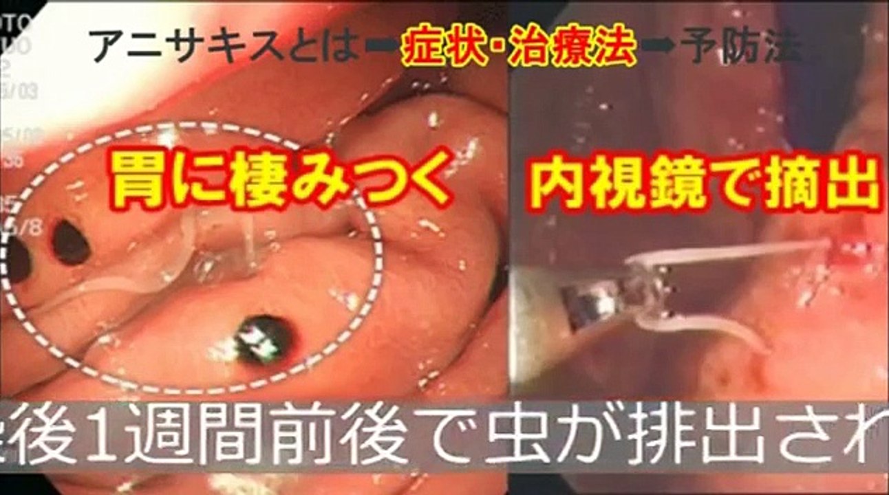【恐怖】日本で急増！胃に寄生する危険な寄生虫！マンゴーワーム、ウマバエより怖い！身近な寄生虫