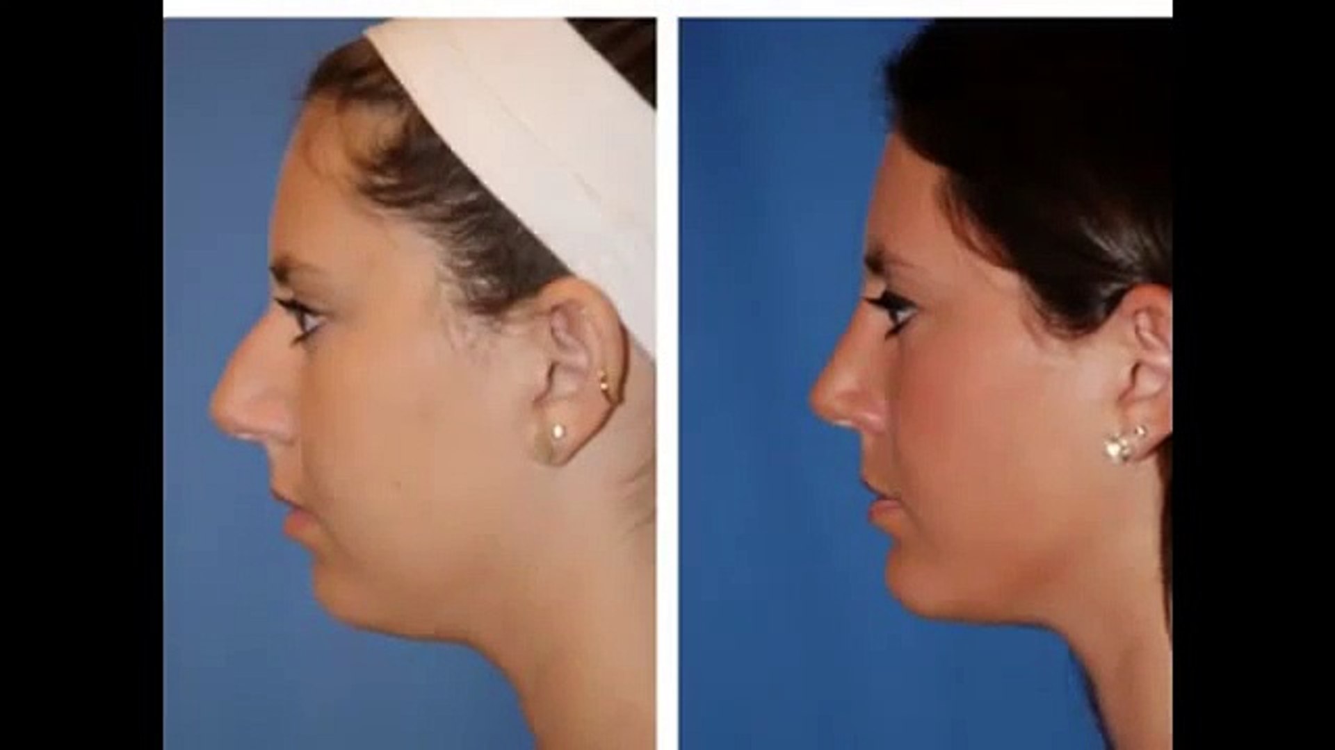 Trends in Facial Plastic Surgery
