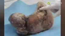 Woman carries ectopic ‘stone baby’ pregnancy in for 37 years