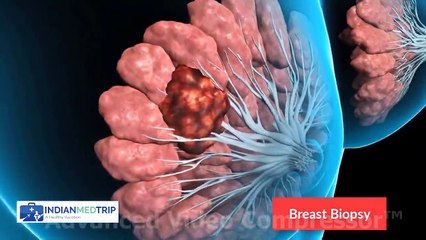 Diagnose Your Breast Cancer With Breast Biopsy Procedure