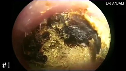 #2 TOP GIANT EAR WAX REMOVAL 2017