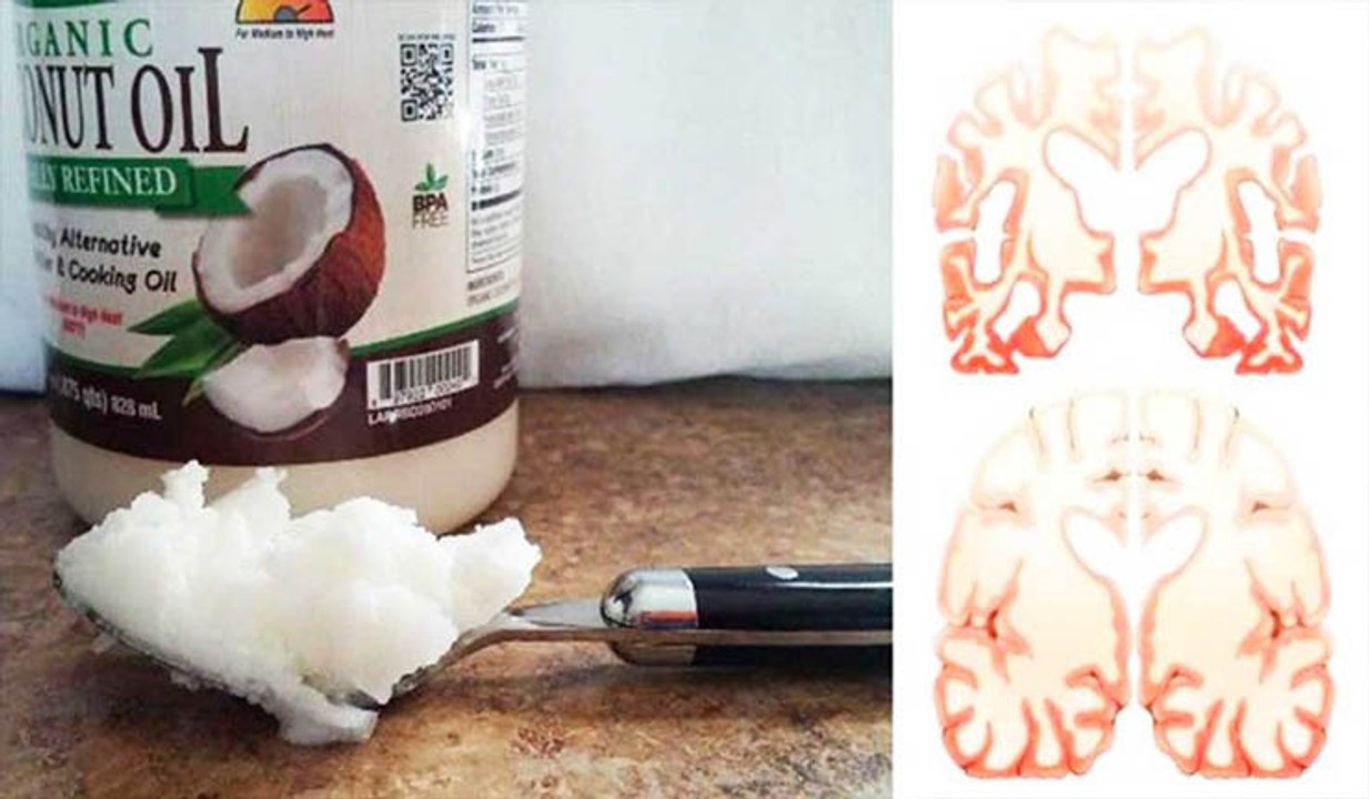 Ele comeu 2 colheres de óleo de coco... O que aconteceu com o seu cérebro... Impressionante!