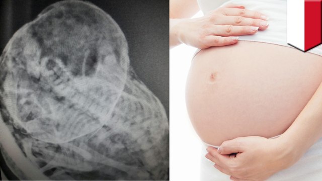 印尼六旬婦　苦懷石胎37年