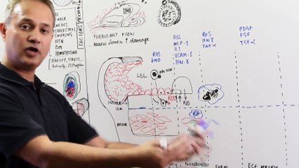 Cellular Events of Atherosclerosis (Part 2)