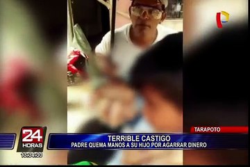 Tarapoto: padre quema manos de su menor hijo como castigo