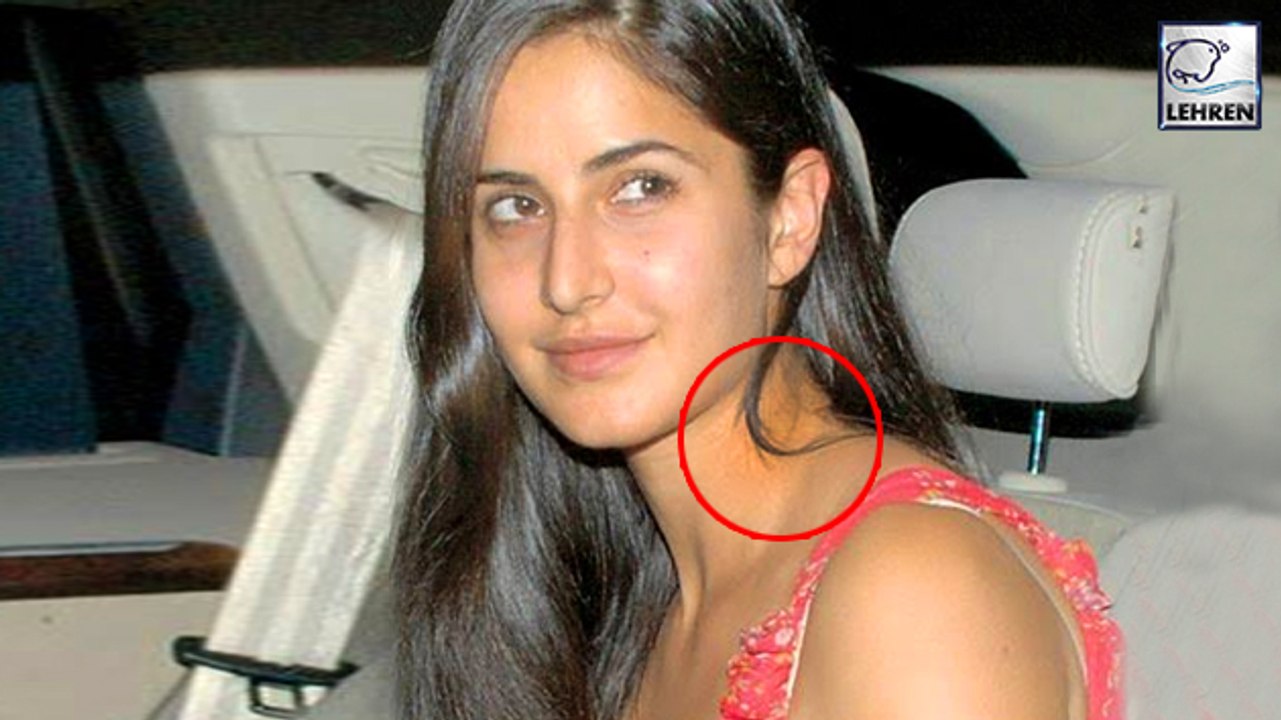 Katrina Kaif Suffers Severe INJURY